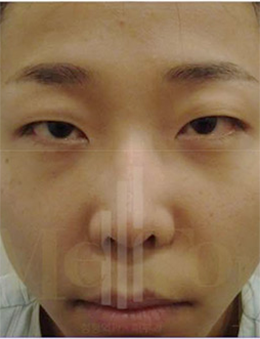 韩国MeTop整形外科眼综合手术对比案例_术前