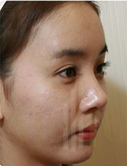 韩国MeTop整形外科面部脂肪填充手术案例