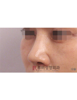 韩国如妃整形外科隆鼻修复手术对比日记