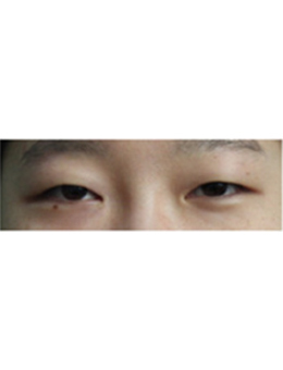 韩国李政自然美整形外科眼综合手术对比日记