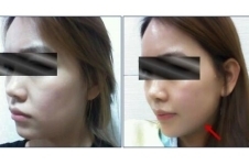 韩国K-beauty整形医院海量案例曝光，提升除皱案例眼前一亮！