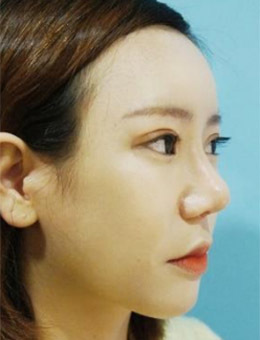 韩国K-Beauty隆鼻+双眼皮脂肪填充3个月恢复案例