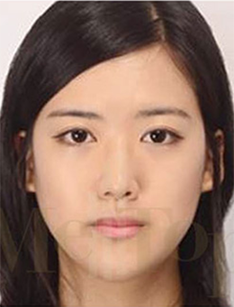 韩国MeTop整形外科面部轮廓整形手术对比案例_术后