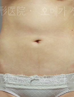 韓國omega整形外科腰腹吸脂案例