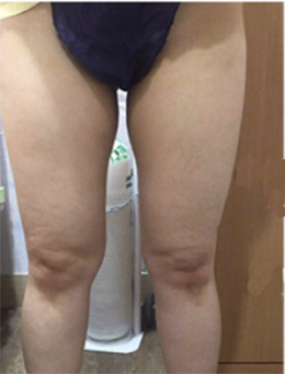 韩国HB整形外科大腿吸脂手术对比案例