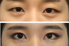 韩国cherish去黑眼圈用什么手术方法？效果怎么样?价格贵吗?