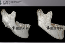 轮廓手术失败不用怕,白汀桓修复人工骨3d打印技术超逆天!