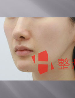 韩国H白汀桓整形外科鼻基底手术前后对比
