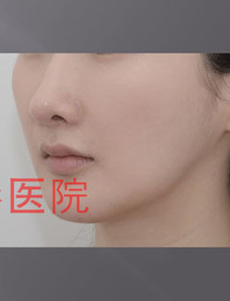 韩国H白汀桓整形外科鼻基底手术前后对比