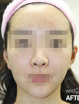 韩国widwin皮肤科面部吸脂案例对比