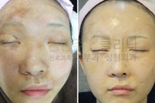 韓國去疤痕醫院排名，安成烈、Dr.ham's、清潭珠顏哪家好？