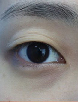 韩国纯真整形医院-韩国纯真双眼皮手术打包图，3~5mm宽度的萌动初恋眼！