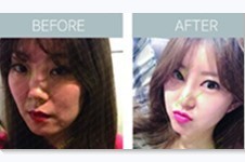 鼻尖短鼻孔外露该怎么修复，韩国40000元修复方案可靠吗？