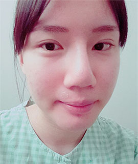 韩国kowon整形外科鼻翼缩小前后对比_术前