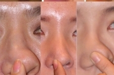 韩国医院垫鼻尖手术怎么做，术后特点有哪些？