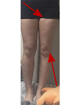 韩国Dr.skinny医院注射瘦大腿案例对比_术前