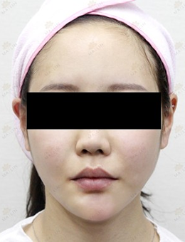 韩国媄潾整形外科面部脂肪填充日记