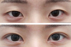 双眼皮有疤痕怎么修复？韩国grida整形医院方法+日记解析！