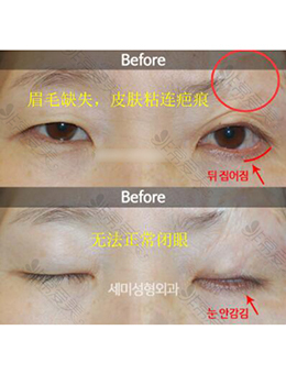 韩国semi整形医院-韩国世美整形外科眼部修复前后对比照片