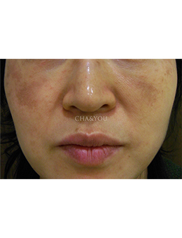 韩国CHA&YOU皮肤科法令纹+祛斑治疗对比案例_术前