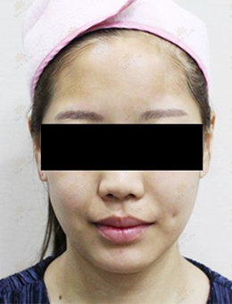 韩国媄潾整形外科面部脂肪填充案例
