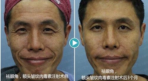 瘦脸和玻尿酸有什么区别？哪家医院瘦脸除皱效果好？