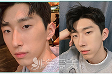韩国模特整形亲身经历告诉你，男生隆鼻后会帅多少！！