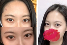 分享我在韩国CRAPAS蜡笔整形医院做双眼皮手术经历！