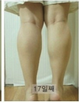 美波mifamoon整形医院-韩国美波瘦脸瘦小腿日记对比效果
