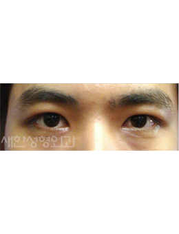 韩国Saehan整形外科-韩国saehan整形外科男士双眼皮手术对比案例