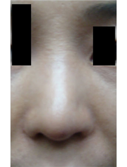 韩国Saehan整形外科-韩国saehan整形外科朝天鼻矫正手术对比案例