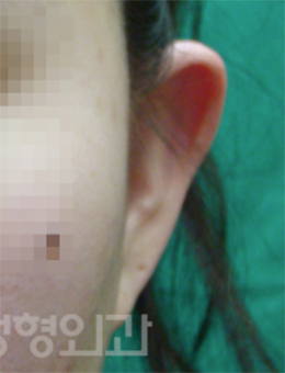 韩国saehan整形外科耳畸形矫正手术对比案例