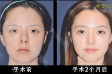 韩国挛缩鼻鼻修复专家都有哪些？排名不分先后顺序！