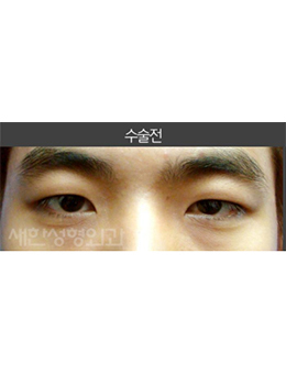 韩国saehan整形外科男士双眼皮手术对比案例