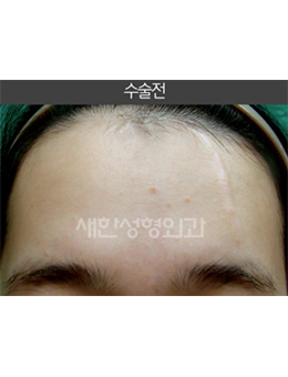 韩国Saehan整形外科-韩国saehan整形外科面部去祛疤手术对比案例