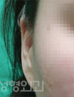 韩国Saehan整形外科-韩国saehan整形外科耳畸形矫正手术对比案例