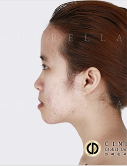 韩国新帝瑞娜整形外科自体软骨隆鼻对比图