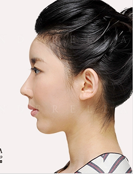 韩国新帝瑞娜整形外科鹰钩鼻矫正对比图