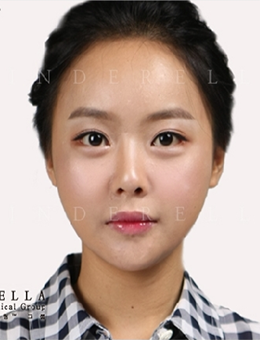 韩国灰姑娘双眼皮修复手术对比日记