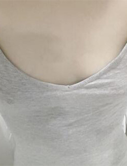 韩国原辰整形外科胸部整形对比案例_术前