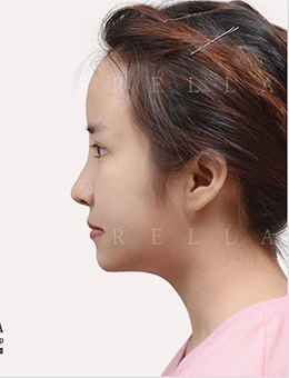 韩国新帝瑞娜整形外科自体软骨隆鼻对比图