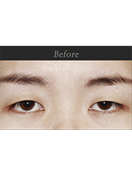 韩国原辰整形外科双眼皮整形对比案例