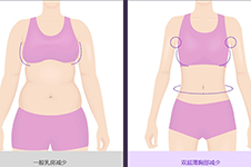 韩国巨乳缩小手术方式有哪些?案例告诉你乳房太大如何缩小