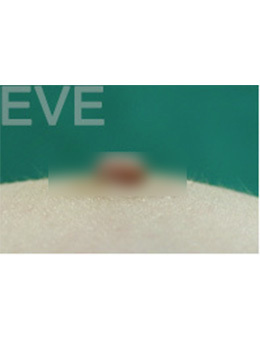 韩国eve整形外科乳头内陷矫正手术对比案例