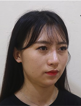 韩国raffine医院下颌缘v脸吸脂对比案例