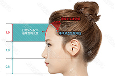 韩国常见的额头缩小方法有几种？手术分别什么原理？