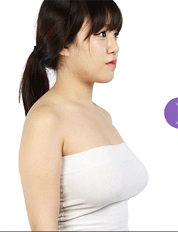 韩国TL整形外科胸部提升手术对比案例_术前