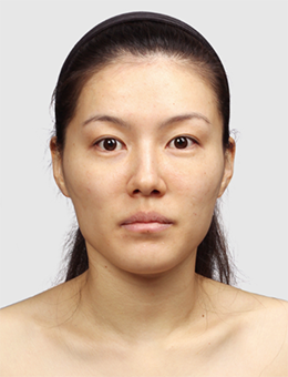 韩国TL整形外科下颌角手术对比案例