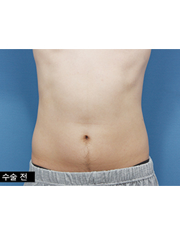 韩国安瑟琳整形外科-韩国安瑟琳医院男士吸脂腹肌整形效果对比图解