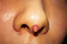 线雕鼻和假体隆鼻哪个更好？线雕鼻有什么危害？